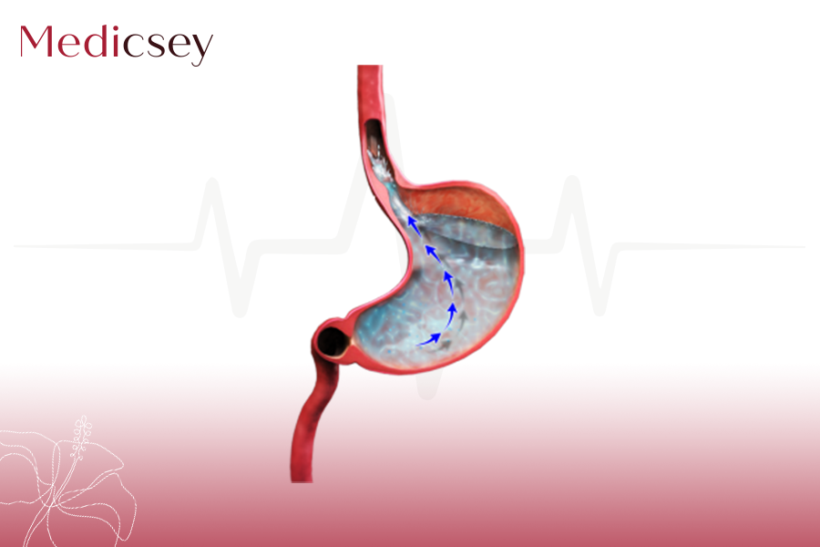 GASTRO ESOPHAGEAL REFLUX DISEASE GERD